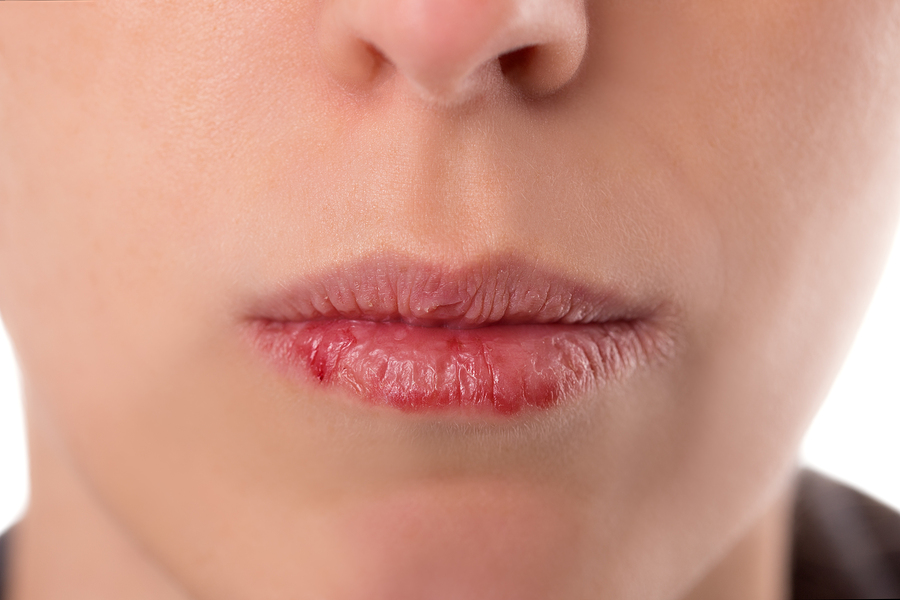 common lip problems
