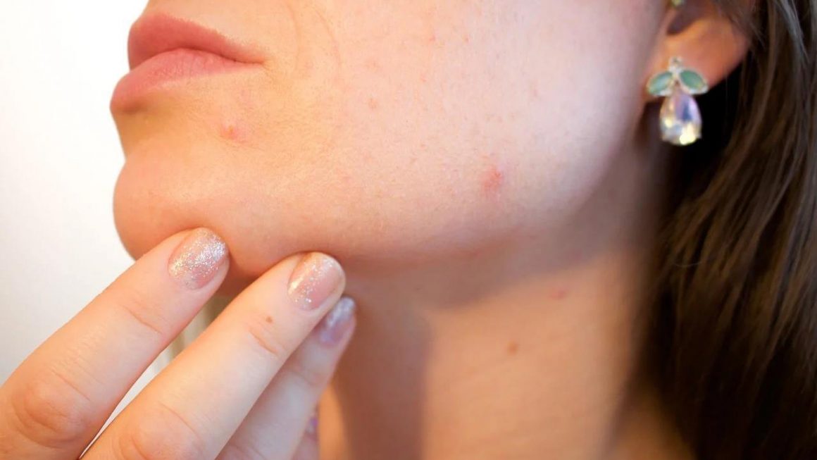 Acne Guide- How Acne is Formed, Prevented and Treated